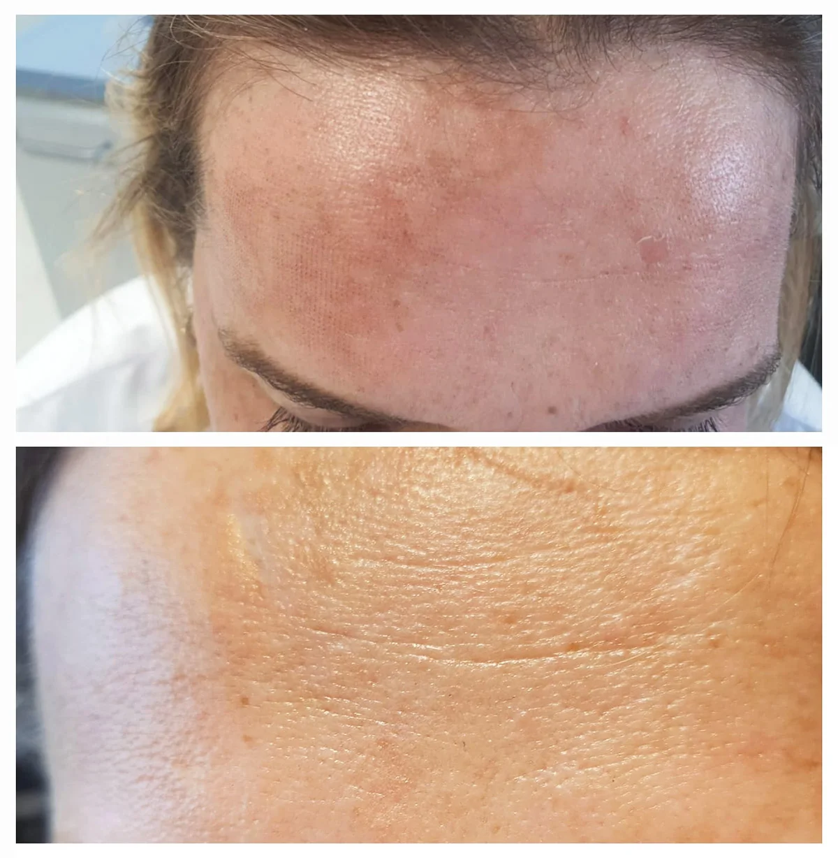 Efekt laser tulowy Efekt laser tulowy