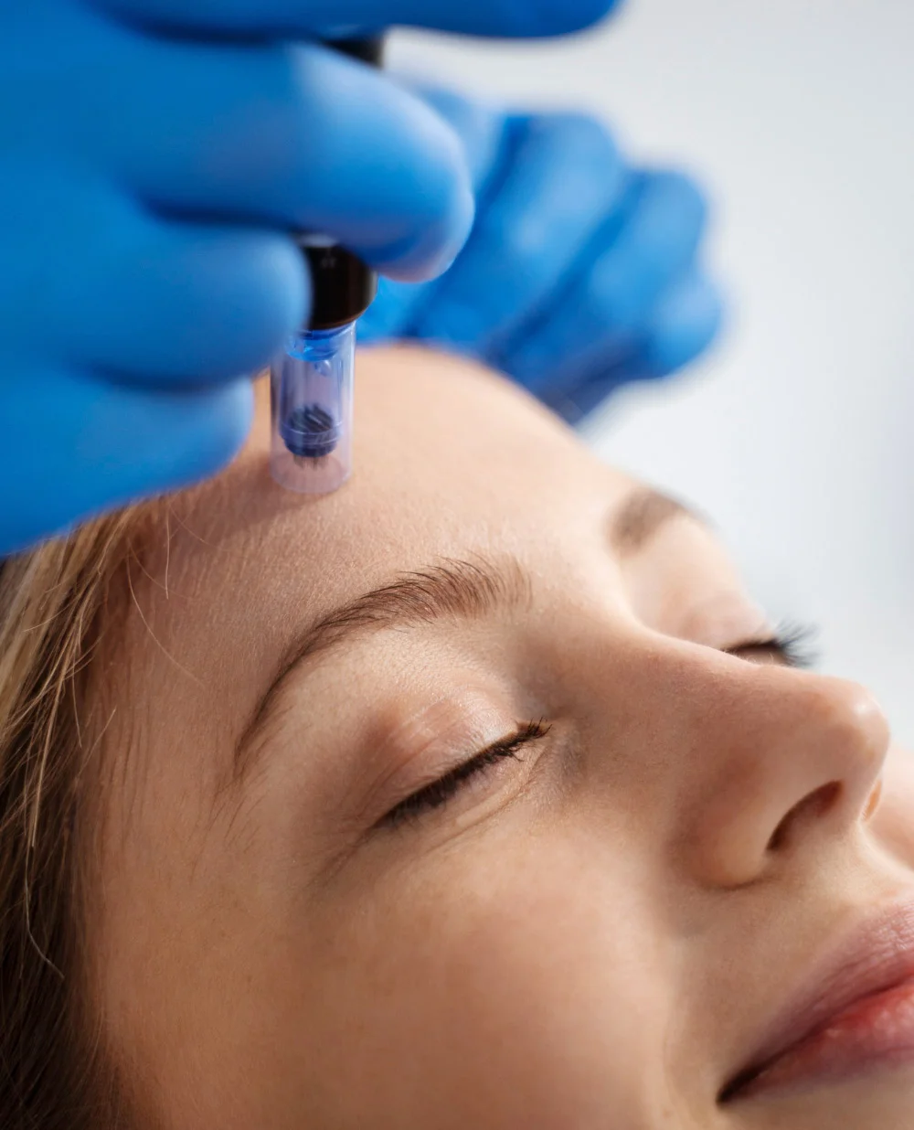 Radiofrekwencja mikroigłowa Płock