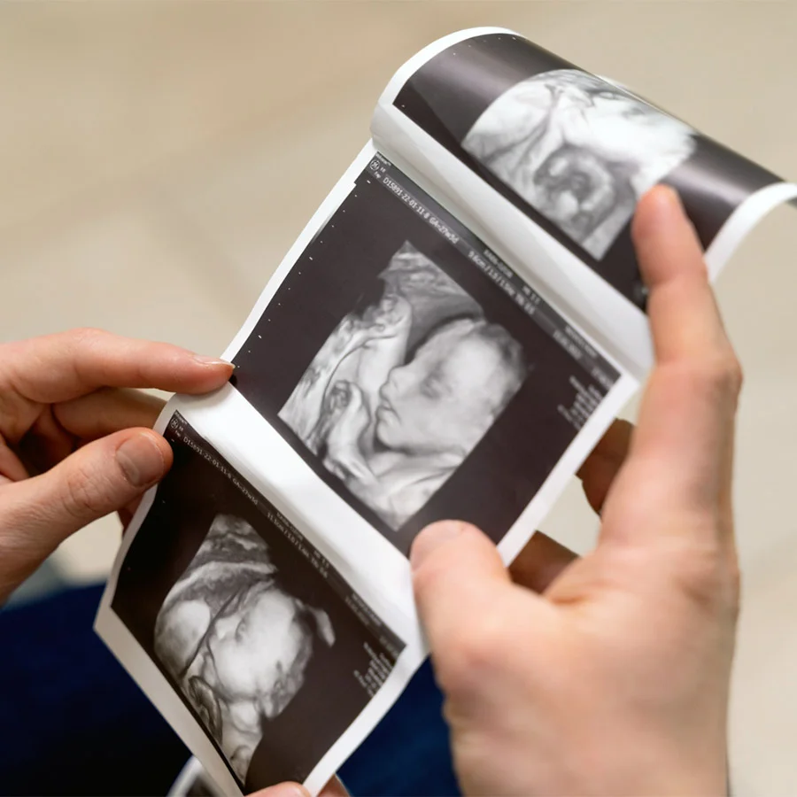 USG 3D ciąży USG 3D ciąży